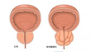 男性前列腺增生有哪些禁忌